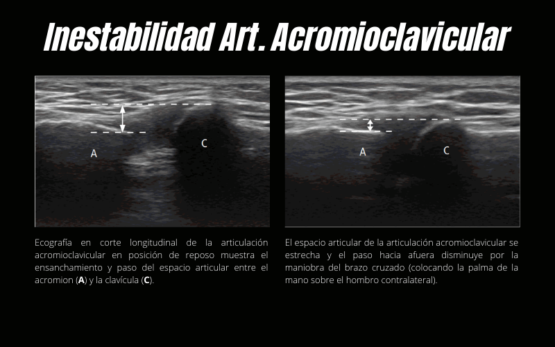 Inestabilidad Articulación Acromioclavicular.png